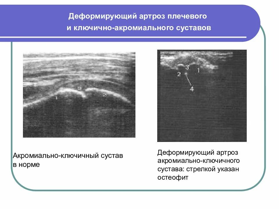 Деформирующий акромиально ключичного сочленения. Деформирующий артроз акромиально-ключичного сустава.