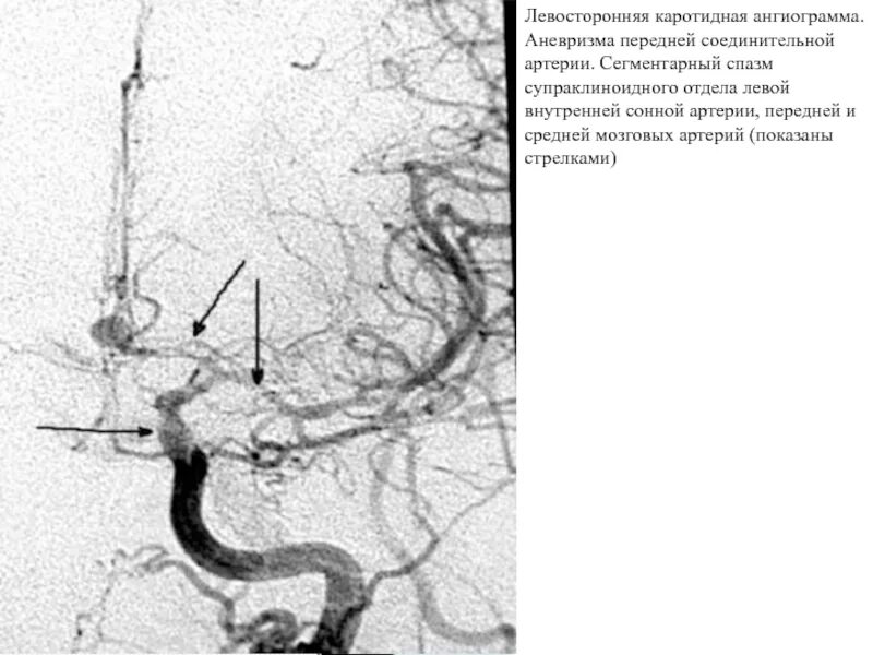 Аневризма сонной артерии что это. Супраклиноидный отдел ВСА аневризма. Аневризма сонной артерии кт. Аневризма супраклиноидного отдела внутренней сонной.