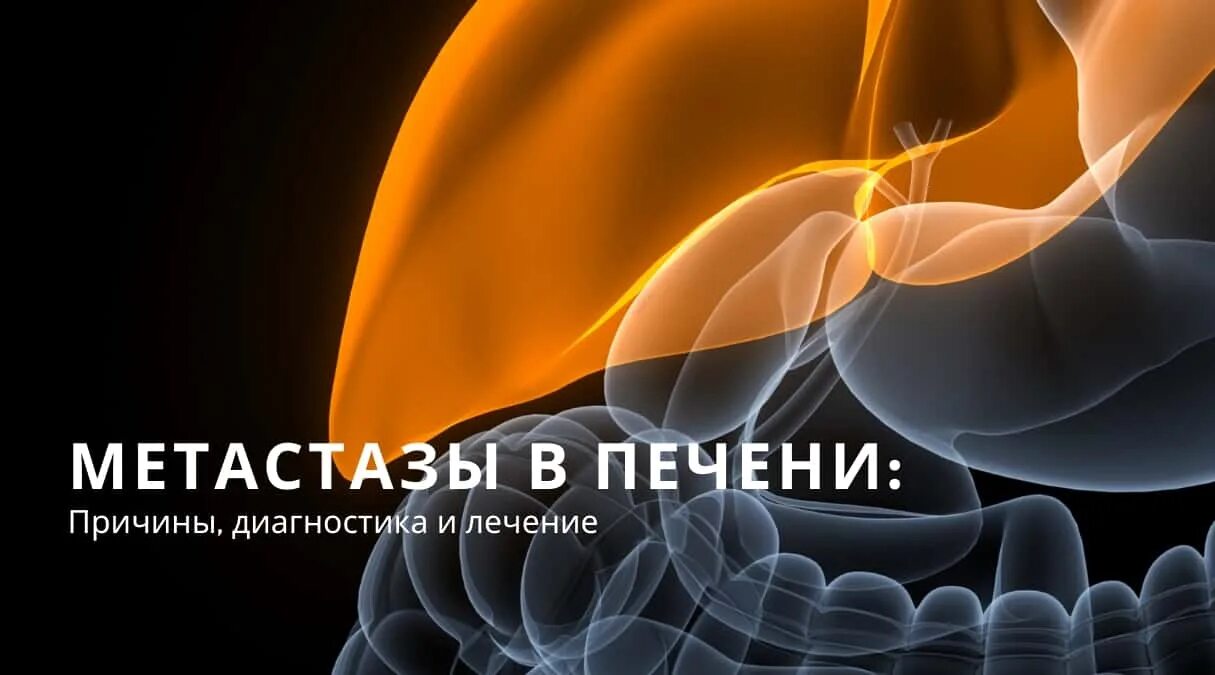 Метастазы в печени 4 стадии отзывы. Метастаз печени жидкость животе.