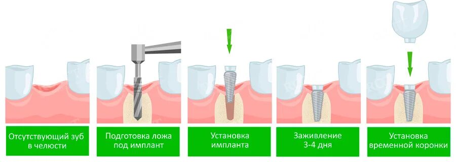 Одноэтапная методика имплантации. Этапы имплантации зубов абатмент. Одноэтапная и двухэтапная имплантация. Этапы дентальной имплантации. 3 зуба установить