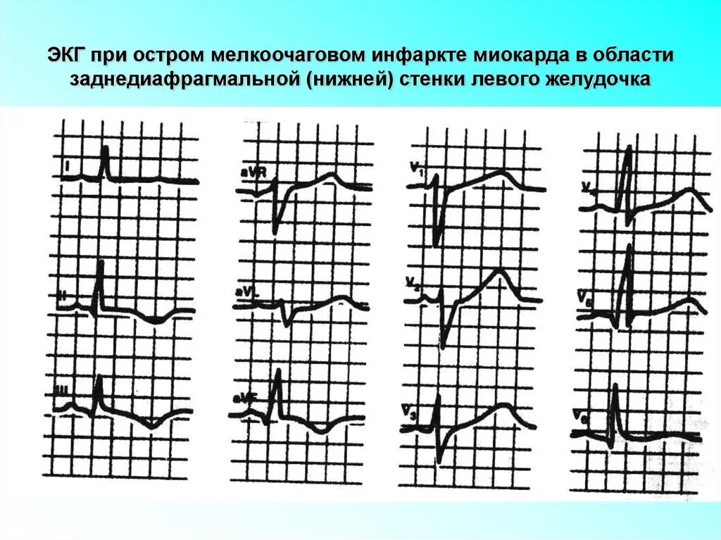 Очаговые изменения левого желудочка. Инфаркт миокарда мелкоочаговый по ЭКГ. Нижний q инфаркт миокарда ЭКГ. Острый Нижний инфаркт миокарда на ЭКГ. Крупноочаговый и мелкоочаговый инфаркт миокарда на ЭКГ.