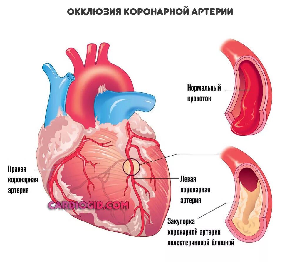 Аортальная стенокардия. Стенокардия картинки. Аортальная стенокардия. Стенокардия патология. Аортальная стенокардия.