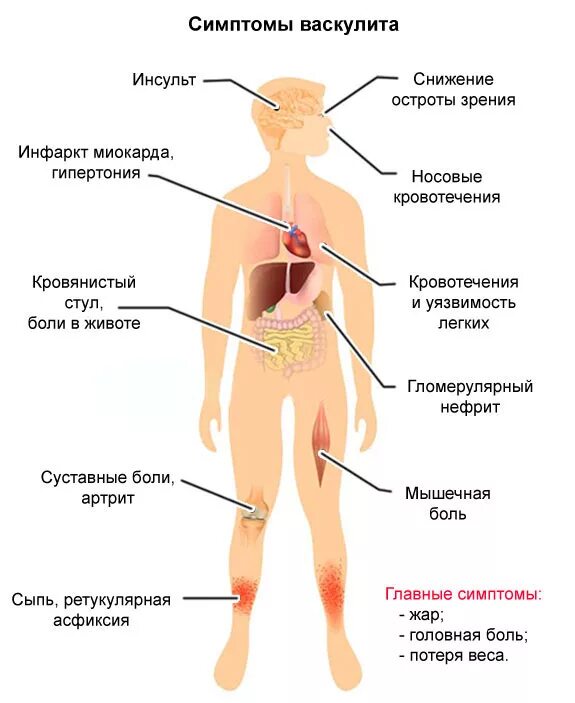 Vascular Diseases MedlinePlus