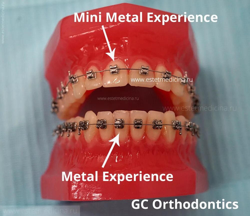 Experience система. Experience Mini Metal GC Orthodontic. Experience брекеты металлические.