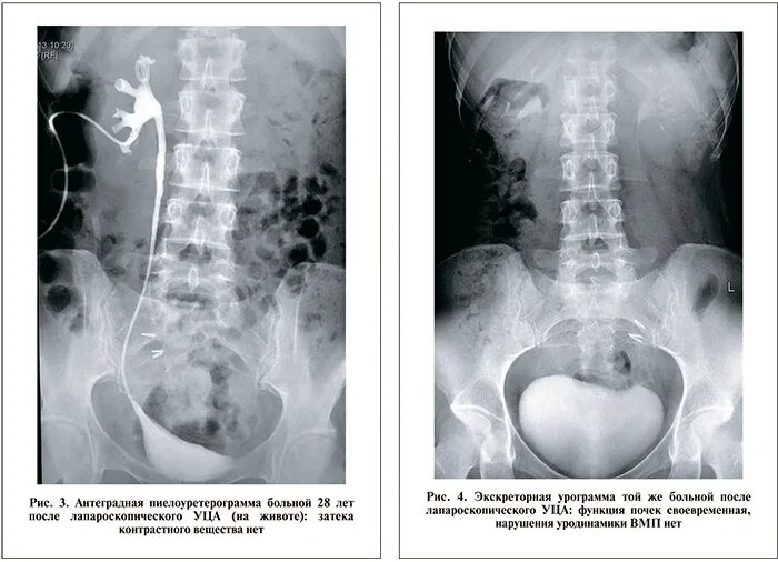 Тазовая часть мочеточника. Нейромышечная дисплазия мочеточника. Уровни мочеточника на рентгене. Стриктура мочеточника на кт. Юкставезикальный отдел мочеточника рентген.