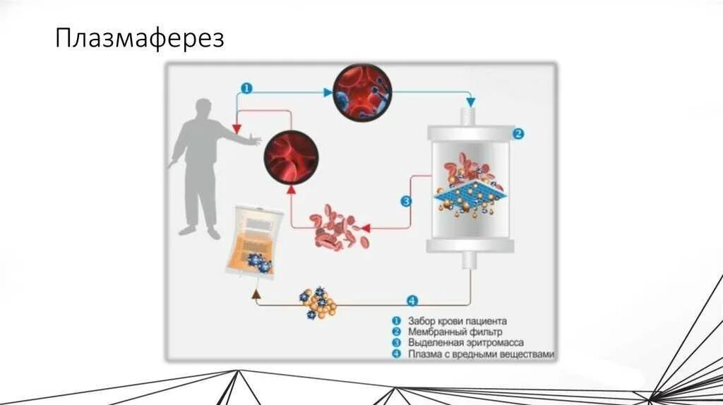 Гемофорез что это. Мембранный плазмаферез схема. Безаппаратный мембранный плазмаферез. Мембранный плазмаферез фильтра. Гемофеникс аппарат для плазмафереза.