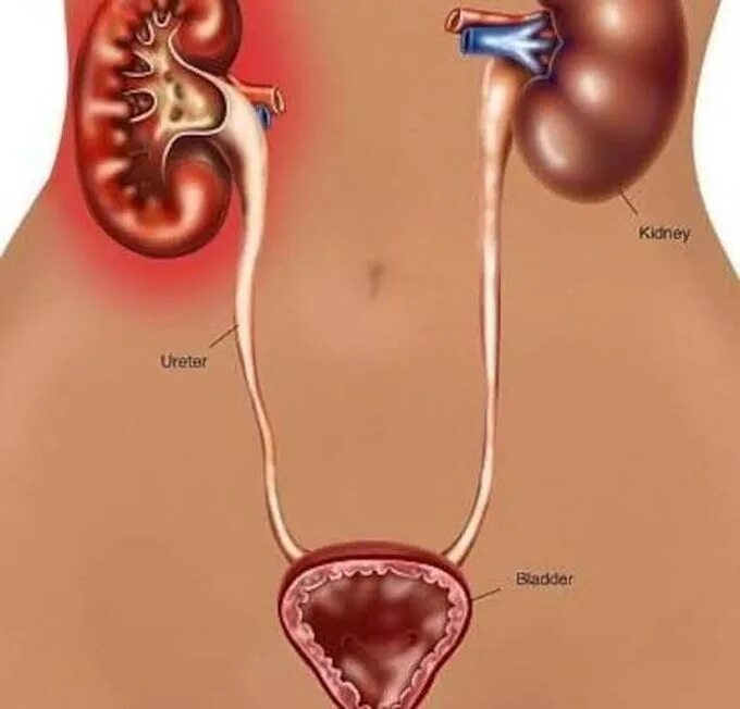 Мочеточник беременность. Пиелонефрит мочевого пузыря. Мочеточник у женщин. Мочеточники у беременных.