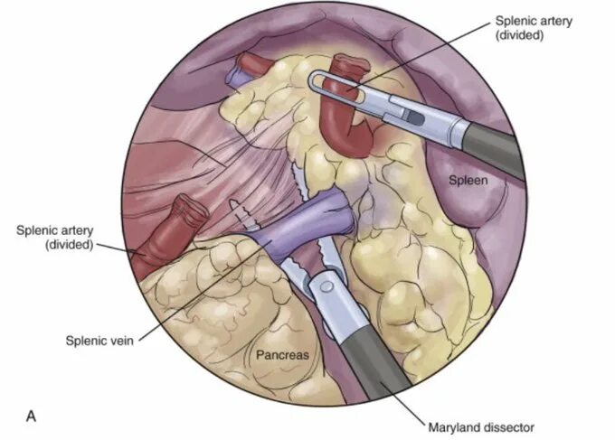 4 surgery. Atlas of Surgical techniques in Traum Demotrios Demetrades MD PHD FACS.