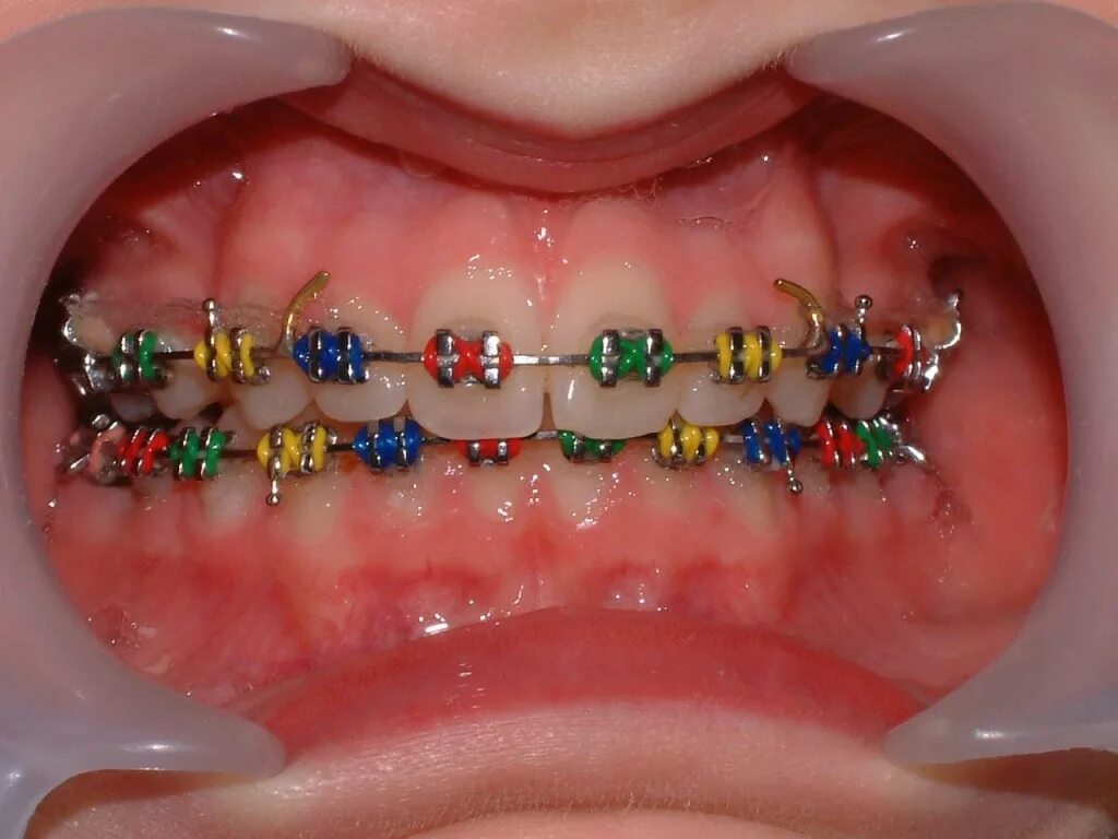 Керамические брекеты damon clear. Скобы пластинки для зубов. Ретейнеры ортодонтические. Металлические лигатурные брекеты. Стоматология брекеты.