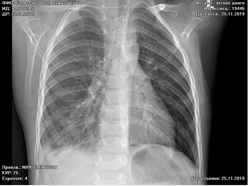 Как выглядит пневмония у ребенка Lobar pneumonia Wikipedia