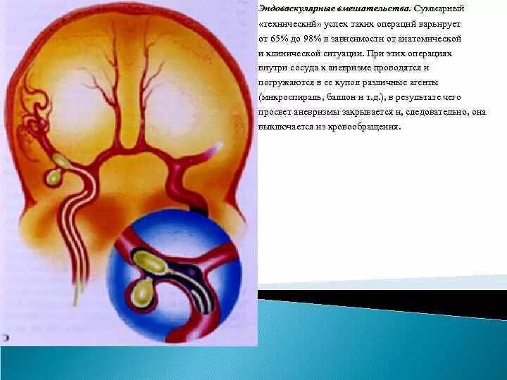 Аневризма головного мозга эндоваскулярным. Эндоваскулярная операция аневризмы головного. Эндоваскулярная аневризма головного мозга. Эндоваскулярная хирургия аневризм артерий головного. Эндоваскулярная операция аневризма мозга.