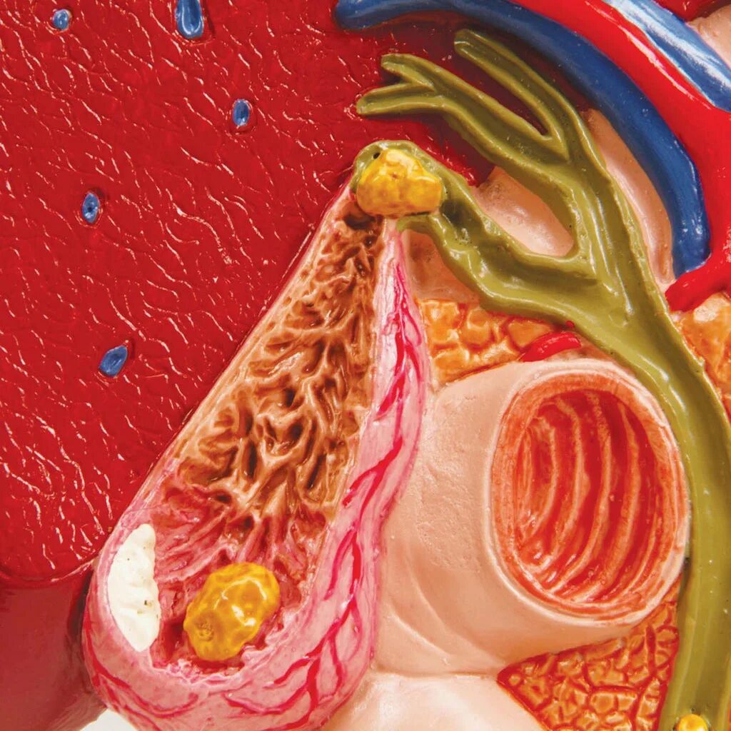 Желчный пузырь под микроскопом. Холестериновые камни в желчном.