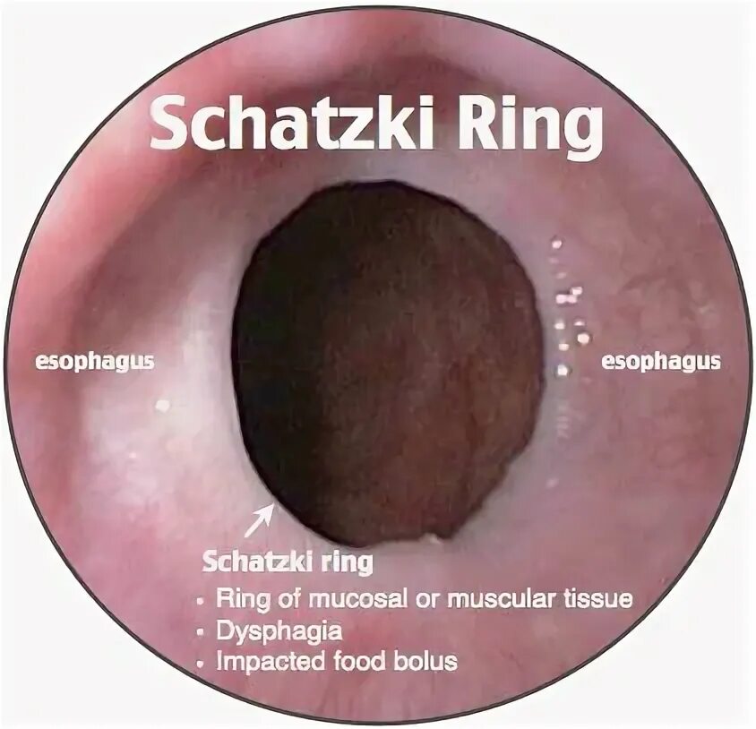 Кольцо шацкого в пищеводе. Пищеводное кольцо Шацкого. Кольцо Шацкого в пищеводе эндоскопическая картина.