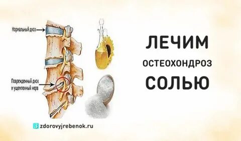 Остеохондроз соли