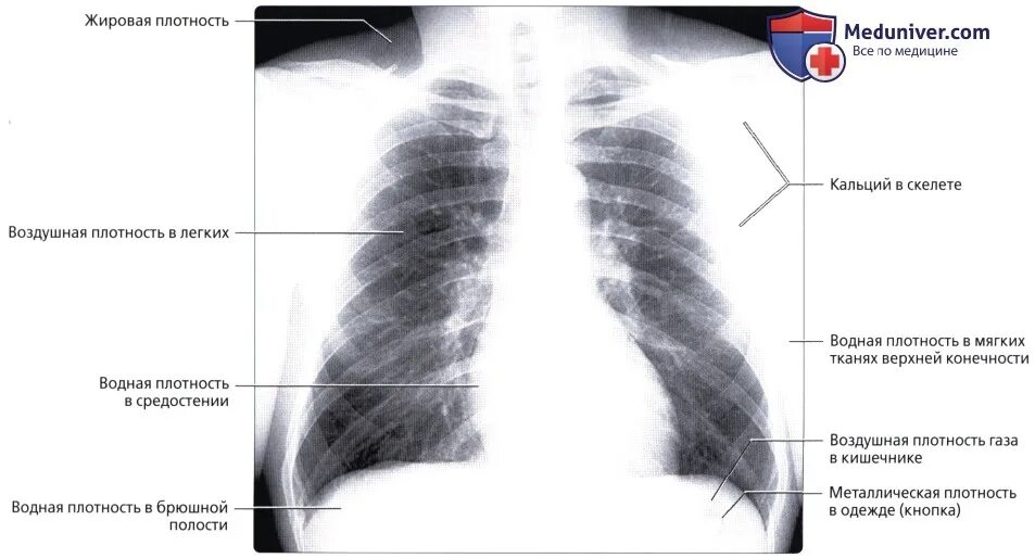 Плотный наблюдаться. Рентгенография грудной клетки средостения. Рентгенографическая плотность. Воздух в брюшной полости на рентгене. Воздух в брюшной полости на рентгене медунивер.
