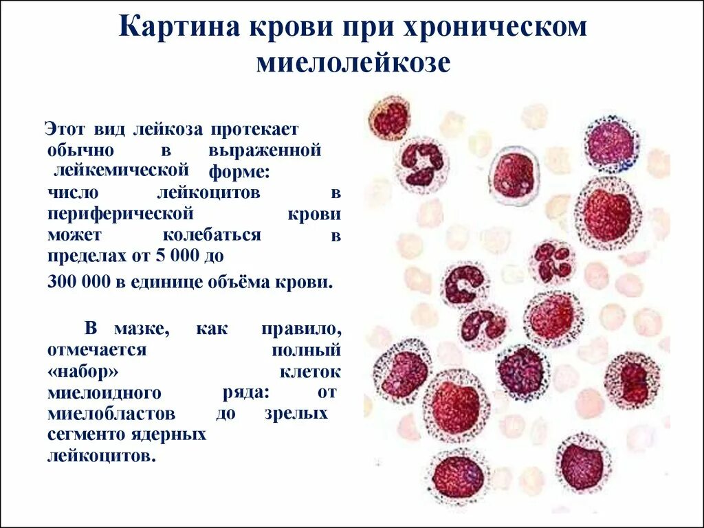 Картина периферической крови при хроническом лейкозе. Хронический миелолейкоз картина крови. Острый миелолейкоз картина крови. Миелоцитарный лейкоз картина крови.