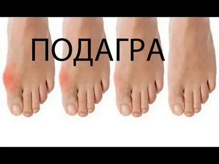 Лечить подагру эффективное