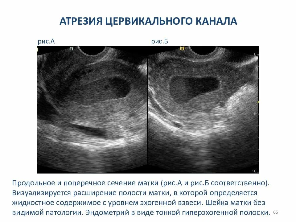 Форма полости матки. Атрезия цервикального канала. Атрезия цервикального канала на УЗИ. Расширение полости матки.