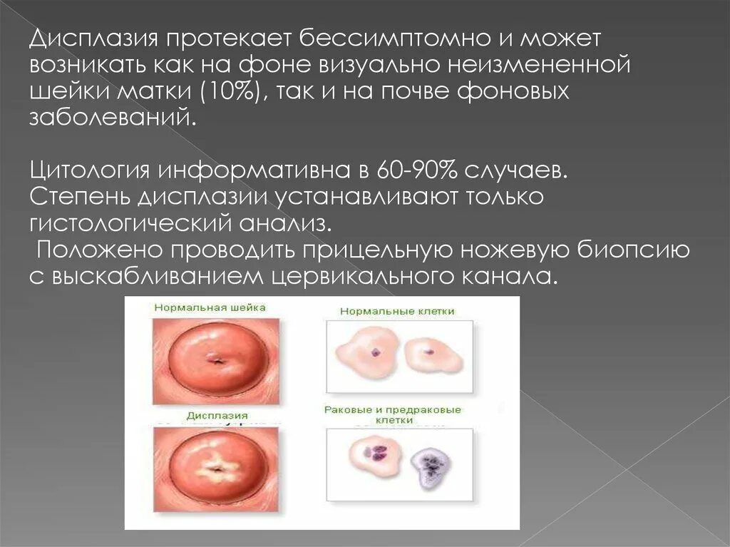 Умеренная дисплазия шейки матки что это. Дисплазия шейки матки степени. Дисплазия шейки стадии.