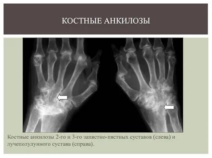Анкилоз