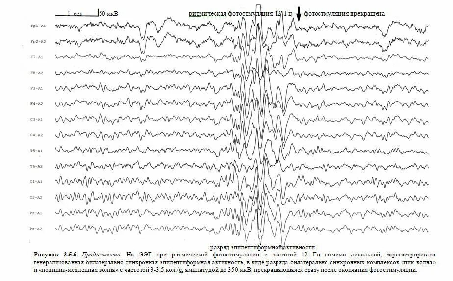 Диффузная активность мозга. Эпилептиформные паттерны на ЭЭГ. Эпилептиформная активность на ЭЭГ. Паттерн типичного абсанса на ЭЭГ. Эпилептиформные феномены на ЭЭГ.