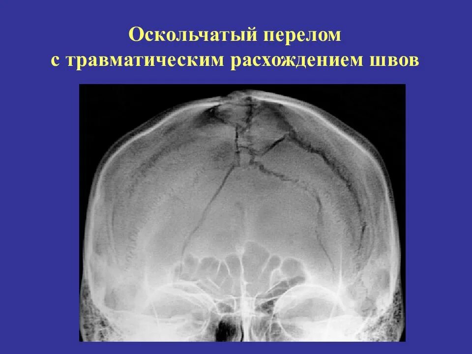 Перелом кости свода черепа. Перелом свода черепа, перелом основания черепа. Оскольчатый перелом лобной кости черепа. Перелом свода черепа рентген.