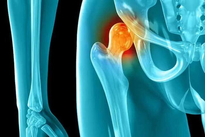 Опухоли тазобедренного сустава на рентгене. Периартрит тазобедренного сустава. Тендиноз тазобедренного сустава. Связки тазобедренного сустава анатомия. Периартроз тазобедренного сустава рентген.