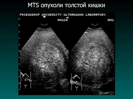 Мтс печени форум