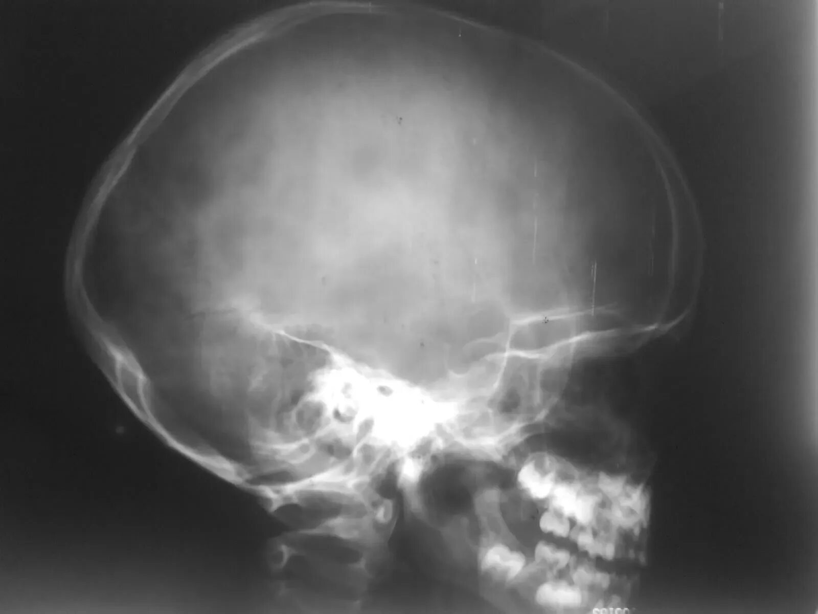 Остеома затылочной кости черепа рентген. Остеома костей черепа рентген. Остеома затылочной кости рентген. Остеома теменной кости на кт.