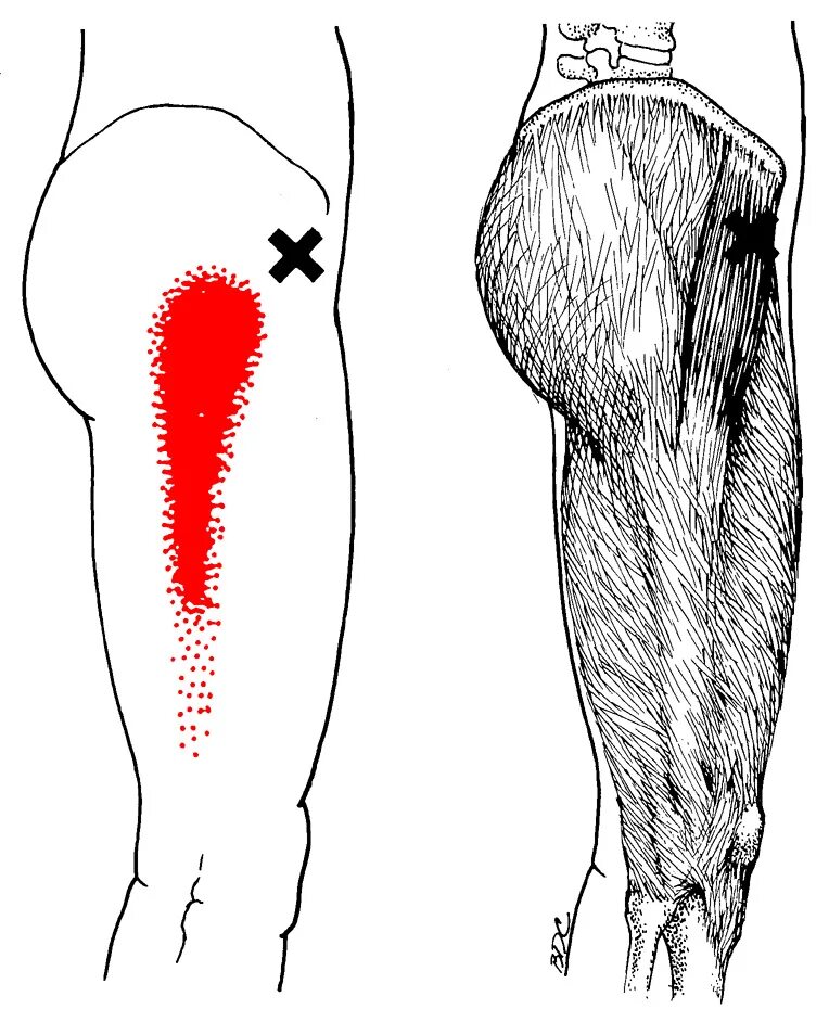 Напрягатель широкой фасции триггерные точки. Большая ягодичная мышца триггерные точки. Триггерные точки мышц бедра. Триггерные точки прямой мышцы бедра.