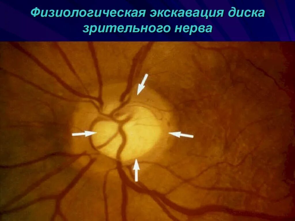 Тотальная экскавация ДЗН. Экскавация глазного дна. Глаукоматозная атрофия зрительного нерва. Периневральное пространство зрительного нерва