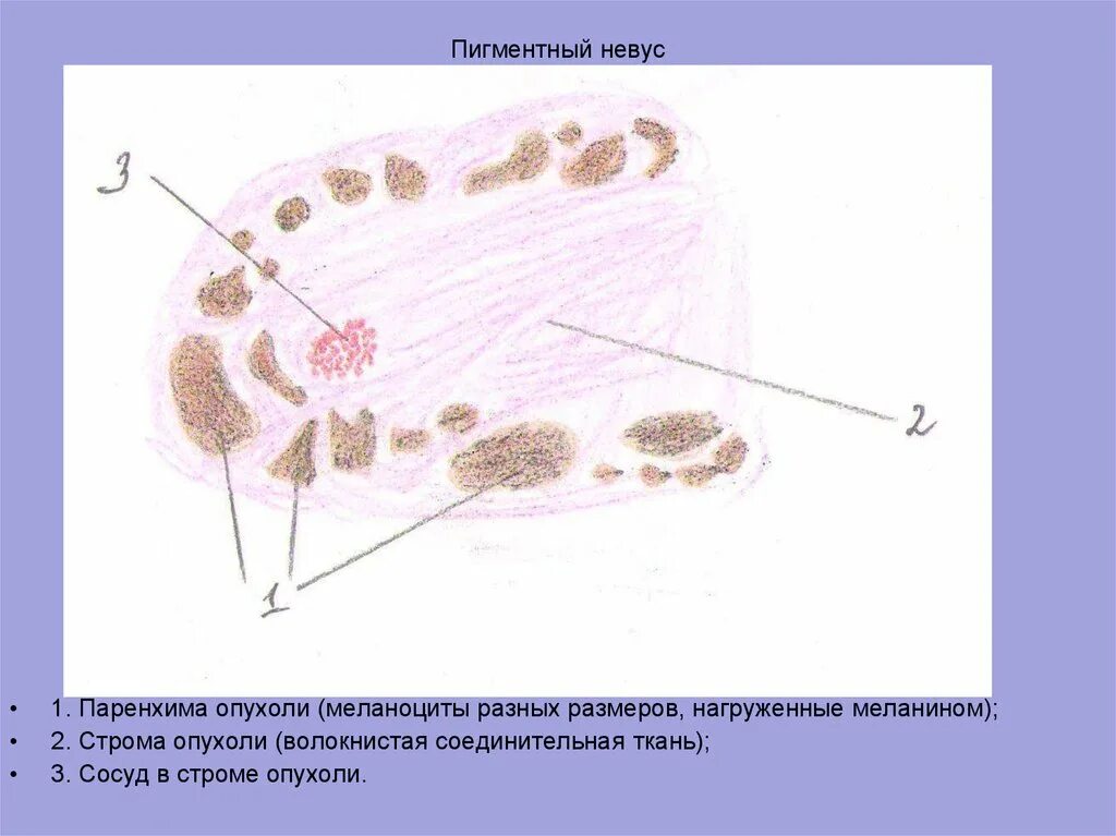 Что такое строма в гистологии. Пигментный невус микропрепарат. паренхима и строма опухоли. строение опухоли строма и паренхима. папилломатозный пигментный невус гистология.