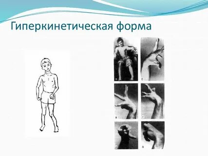 Гиперкинетическую дцп