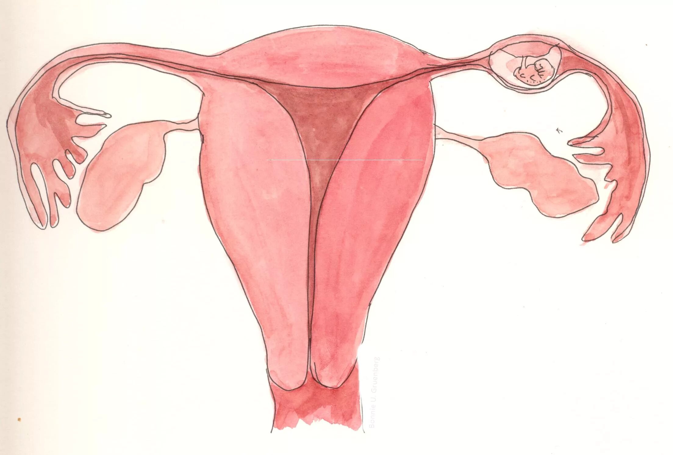 Удаление матки будут ли месячные. Внематочная Трубная беременность. Маточные трубы при беременности. Матка внематочная беременность. Внематочная беременность Трубная беременность.