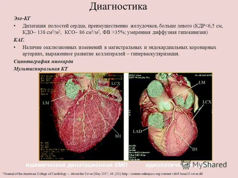 Изменения миокарда левого желудочка сердца