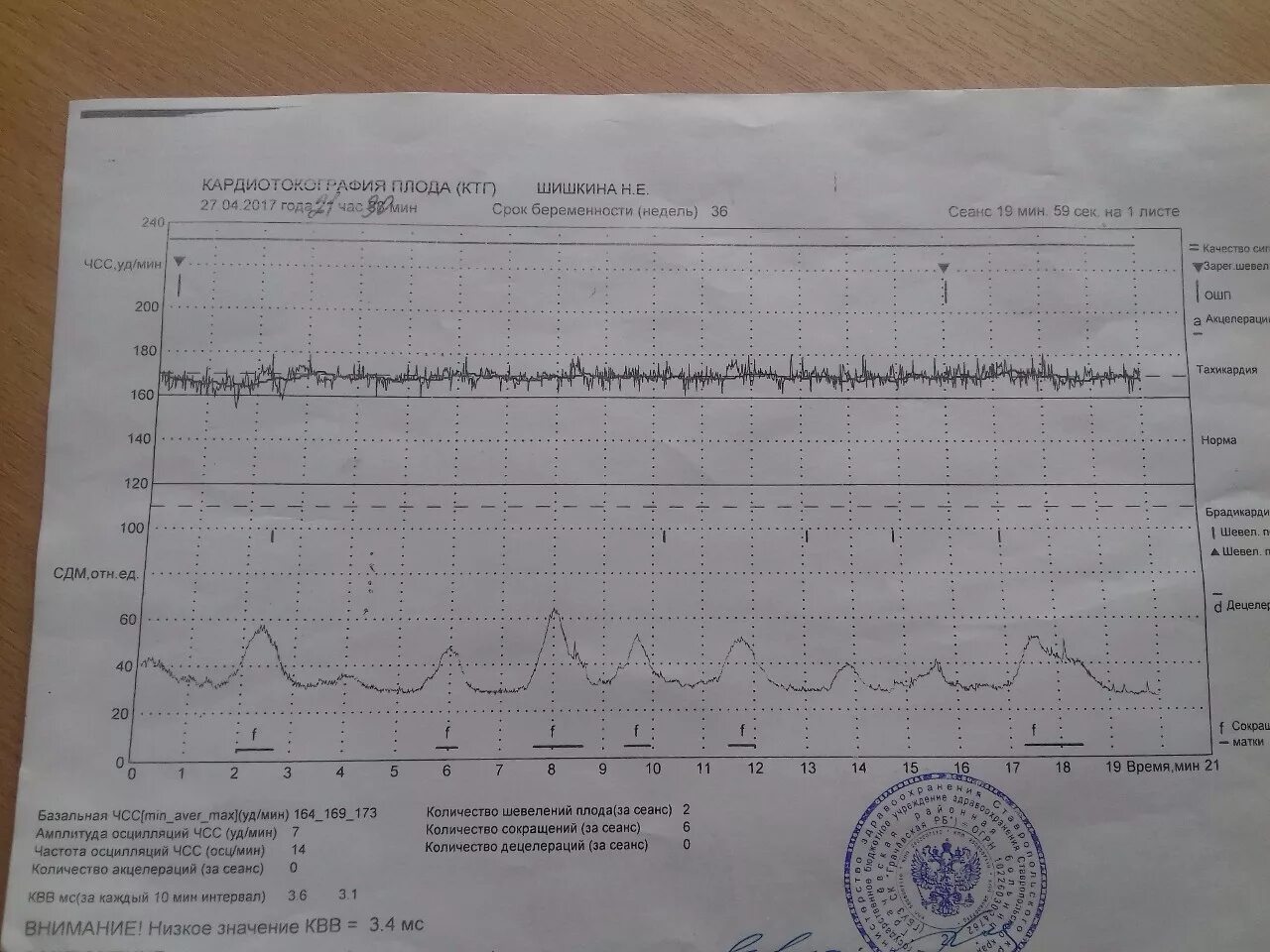 Исследование сердцебиения плода. КТГ при беременности 37 недель показатели. Вариабельность сердечного ритма КТГ. Показатели на аппарате КТГ. Нормальная диаграмма КТГ.