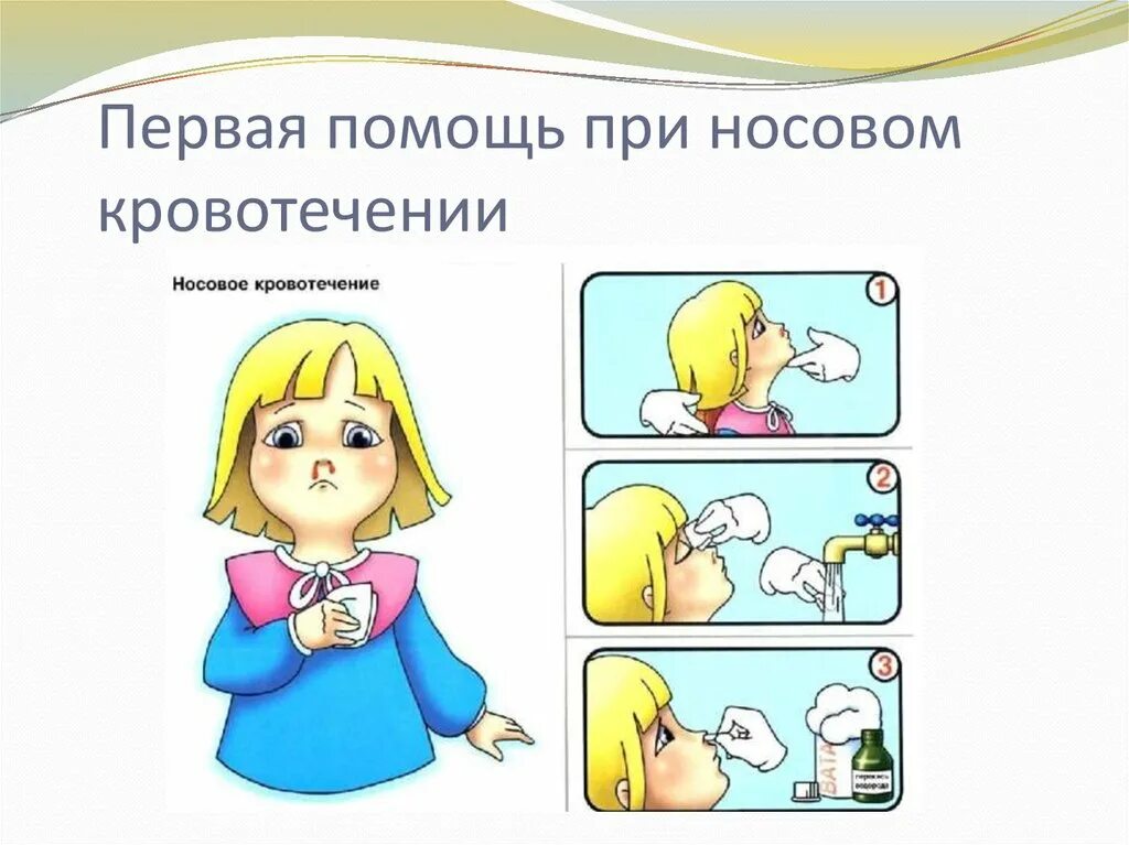 Первая помощь при носовом кровотечении алгоритм. Оказание первой помощи при носовом кровотечении. носовое кровотечение первая помощь. оказание первой помощи при кровотечении из носа. оказание первой мед помощи при носовом кровотечении.