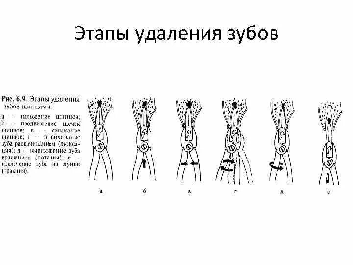 Методика операции удаления зуба. Методика проведения операции удаления зуба. Инструментарий.. Этапы операции удаления зубов. Операция удаления зуба этапы проведения.