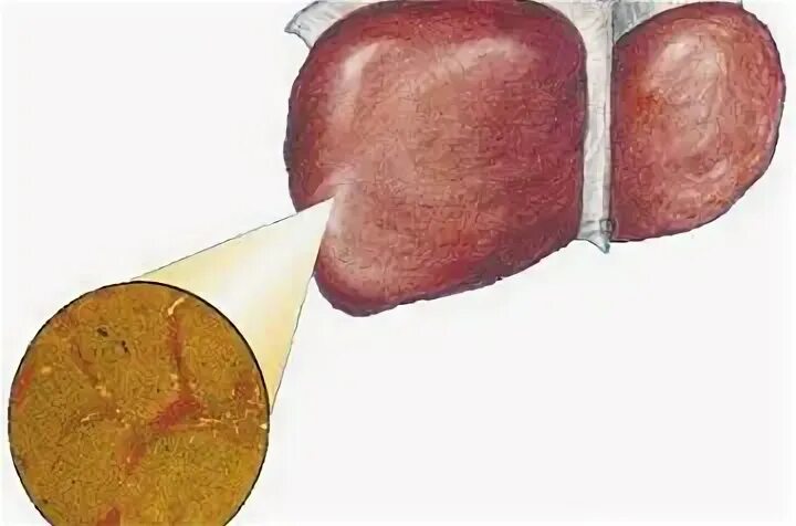 Диффузный фиброз печени. Фиброзный цирроз печени. перидуктальный фиброз печени. мостовидный фиброз печени. перивенулярный фиброз.