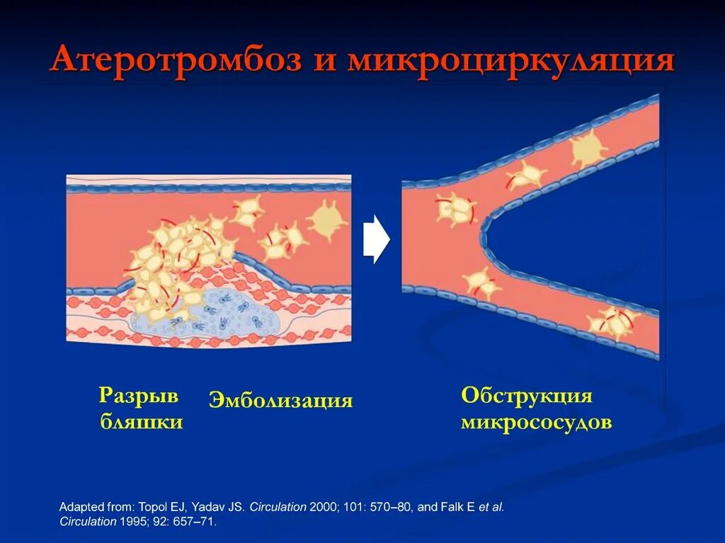 Против атеросклероза