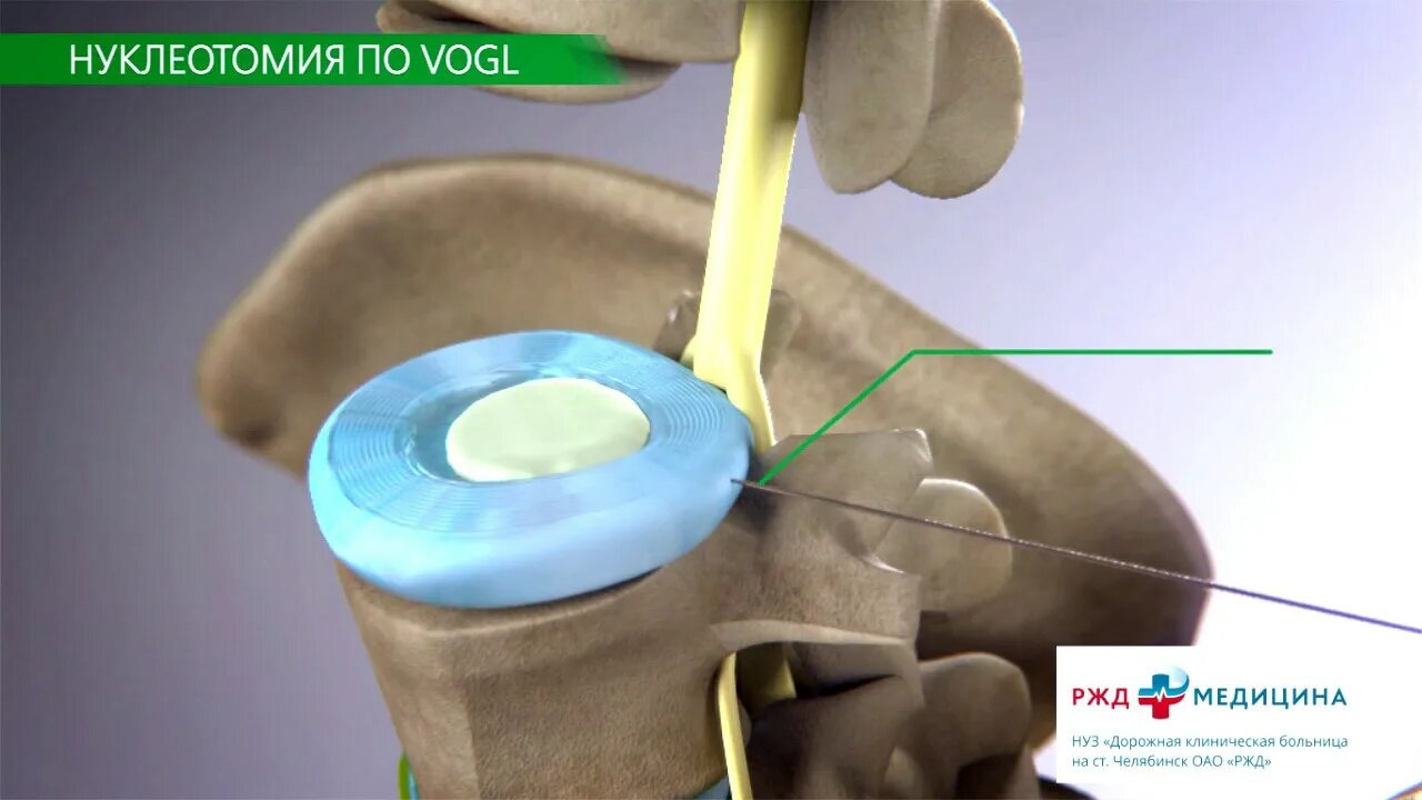 Нуклеопластика межпозвонкового. Нуклеопластика грыжи позвоночника. Лазерная нуклеотомия межпозвонкового диска. Грыжа лазерная операция