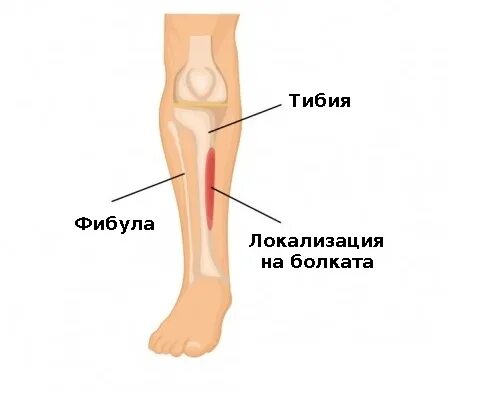 Надкостница костей голени. Боль в надкостнице голени.