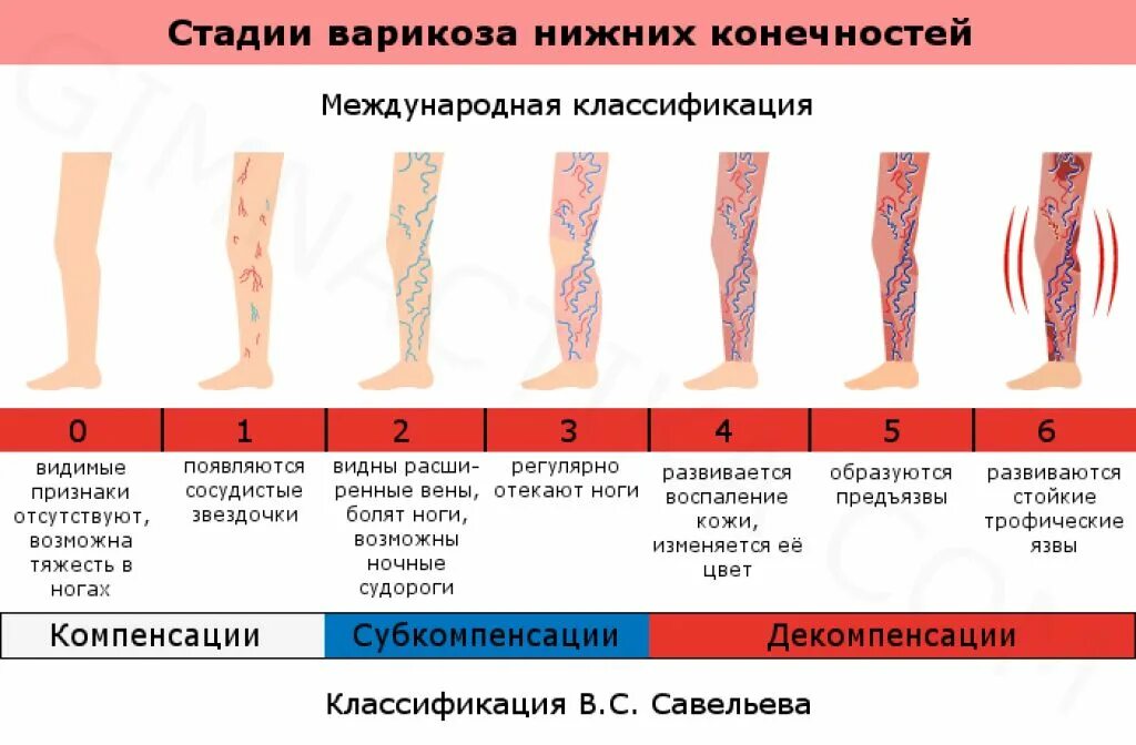 Сильно болит нога после операции. Стадии хронической венозной недостаточности. Хроническая венозная недостаточность степени. Варикозное расширение вен стадии. Варикозная болезнь вен нижних конечностей классификация.