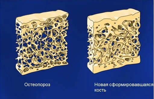 Остеопороз. Что такое эпифизарный остеопороз стопы. Osteoporosis bones. Кальций в костной ткани. Osteoporosis bones.