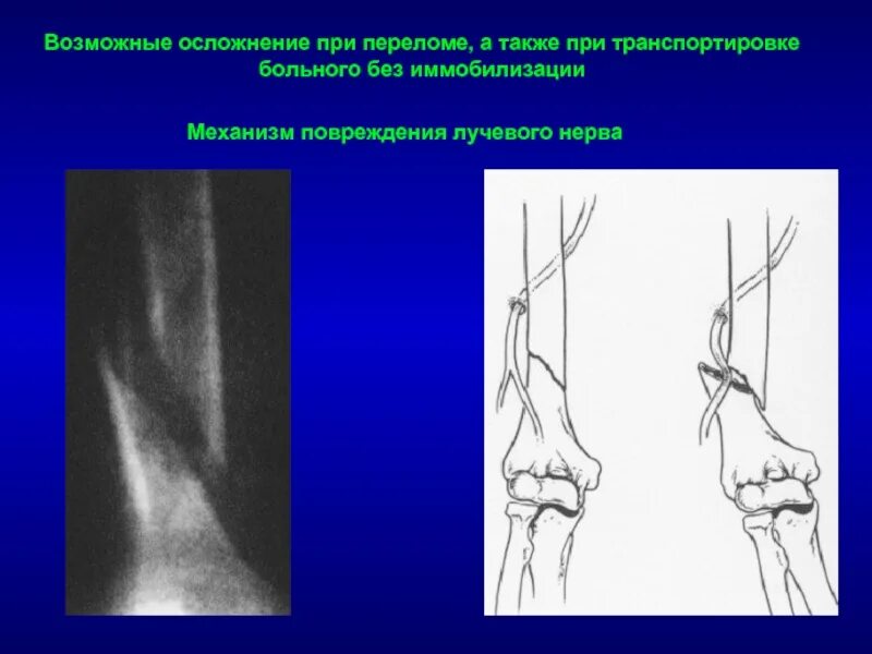 Повреждение лучевого нерва. Повреждение лучевого нерва при переломе.