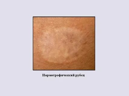 Ткань рубца