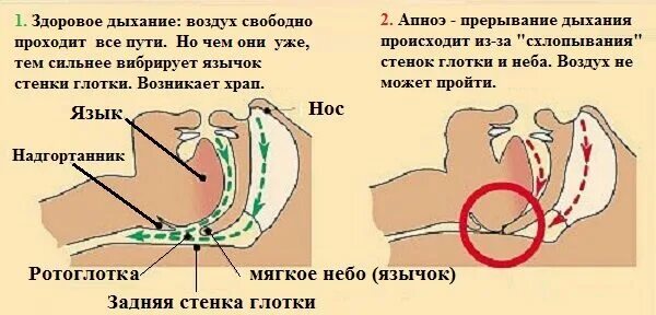 Почему появляется храп. Упражнения от апноэ сна.