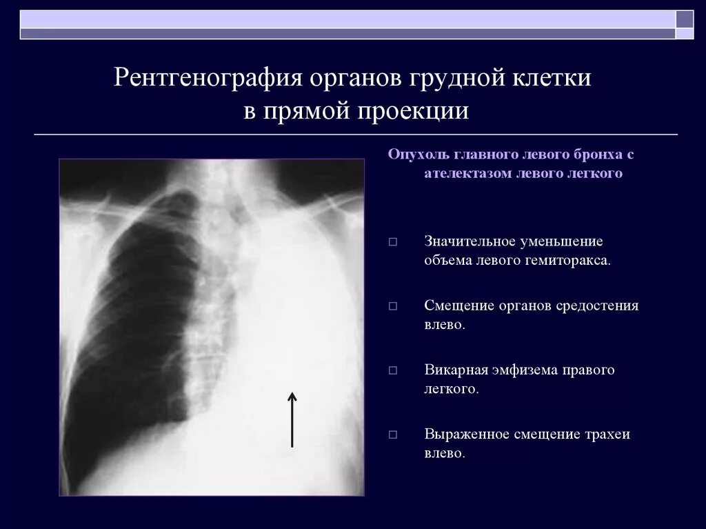 Признаки ателектаза легкого. Ателектаз доли рентген. Ателектаз рентген заключение. Рентген грудной клетки в боковой проекции норма. Рентген грудной клетки с описанием боковая проекция.