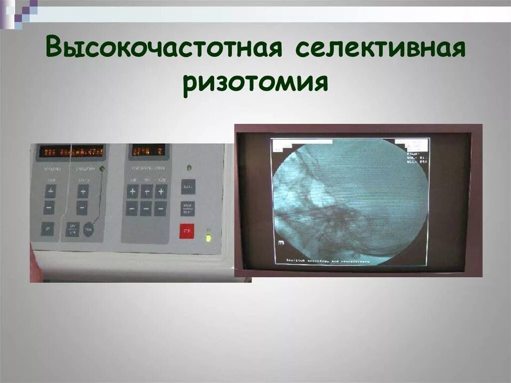 Селективная дорсальная ризотомия (сдр). Селективная ризотомия. Sdr. Селективная дорзальная ризотомия что это. Селективная ризотомия.