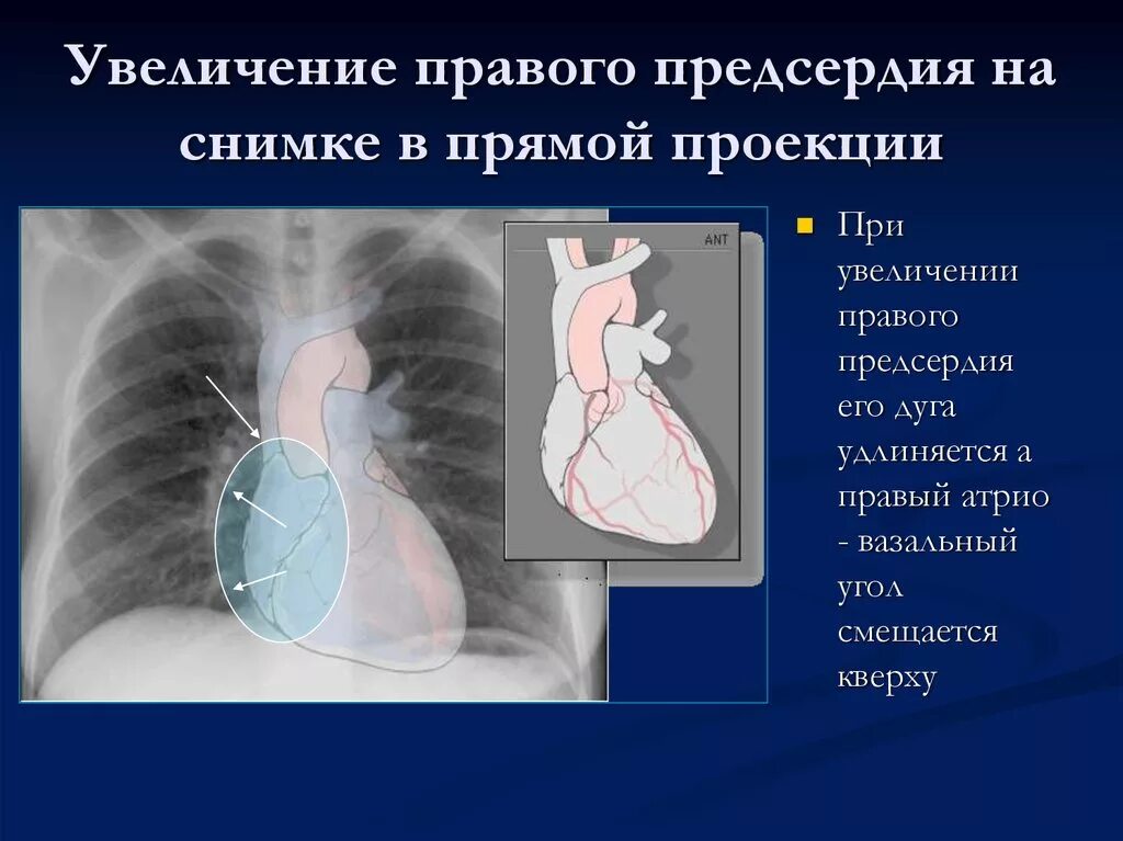 Гипертрофия левого желудочка сердца рентген. Увеличение правого предсердия рентген. Гипертрофия правого предсердия рентген. Гипертрофия правого предсердия на рентгенограмме. Левое предсердие увеличено